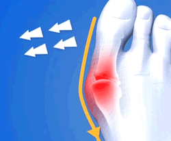 Elastic Bunion Corrector – goalshopper | Bunion cure, Skin problems, Natural remedies