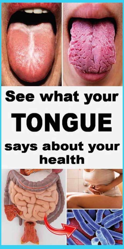 What Your Tongue Says About Your Health In Ayurved What Your Tongue Says About Your Health In Ayurved