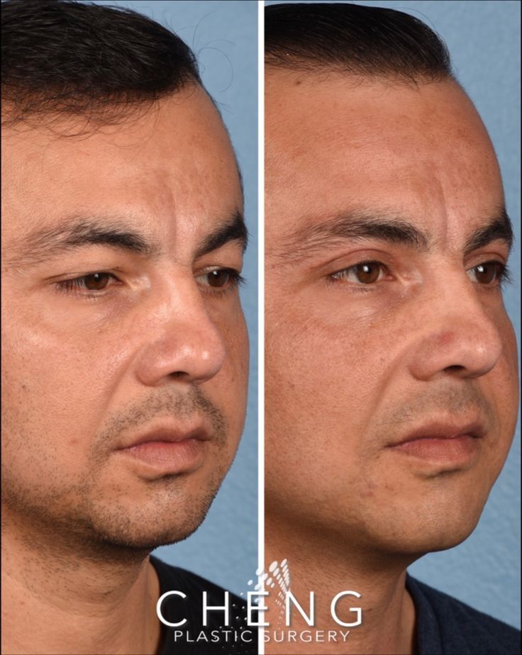 Our patient is a 39-year-old male who had been bothered by his upper eyelid aging for a few years and was ready to embark on a surgical procedure!😎🙌🏽 What is an Upper Blepharoplasty?🤔 Upper blepharoplasty is a great solution to lift/remove excess skin in addition to tightening the muscles behind the eyes! Eyelid Lift, Extra Skin, Eyelid Surgery, Excess Skin, Upper Eyelid, Plastic Surgery, Tighten, Aging, Expressions