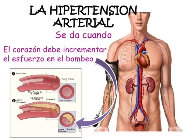 ¿Se puede tratar completamente la presión arterial alta?