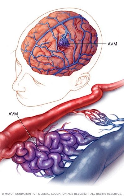 Image Showing Normal And Abnormal Blood Vessels Gross Anatomy Brain Image Showing Normal And Abnormal Blood Vessels Gross Anatomy Brain