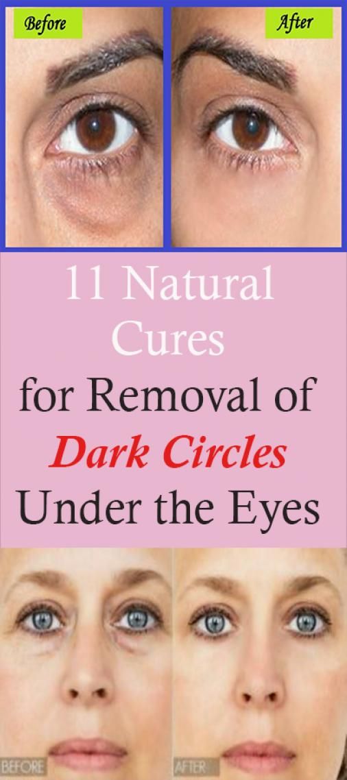 11 Natural Cures for Removal of Dark Circles Under the Eyes #bodyskinconditionan...