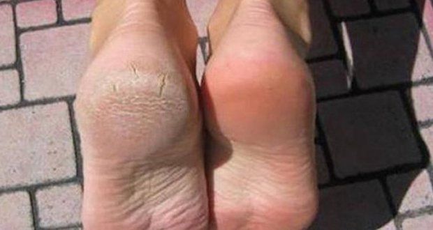 enlever corne pied pedicure enlever corne pied pedicure