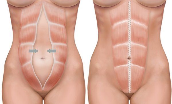 gimnasia abdominal hipopresiva tras la cesárea