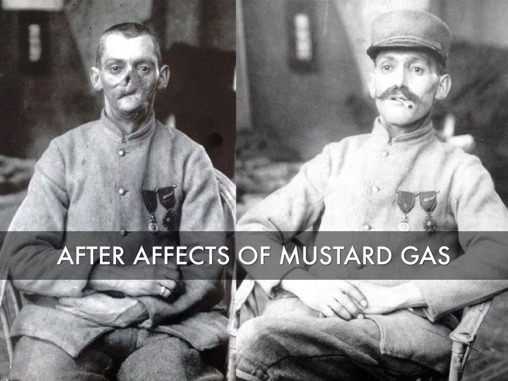 After Affects Of Mustard Gas WWI World War First World World War One after-affects-of-mustard-gas-wwi-world-war-first-world-world-war-one