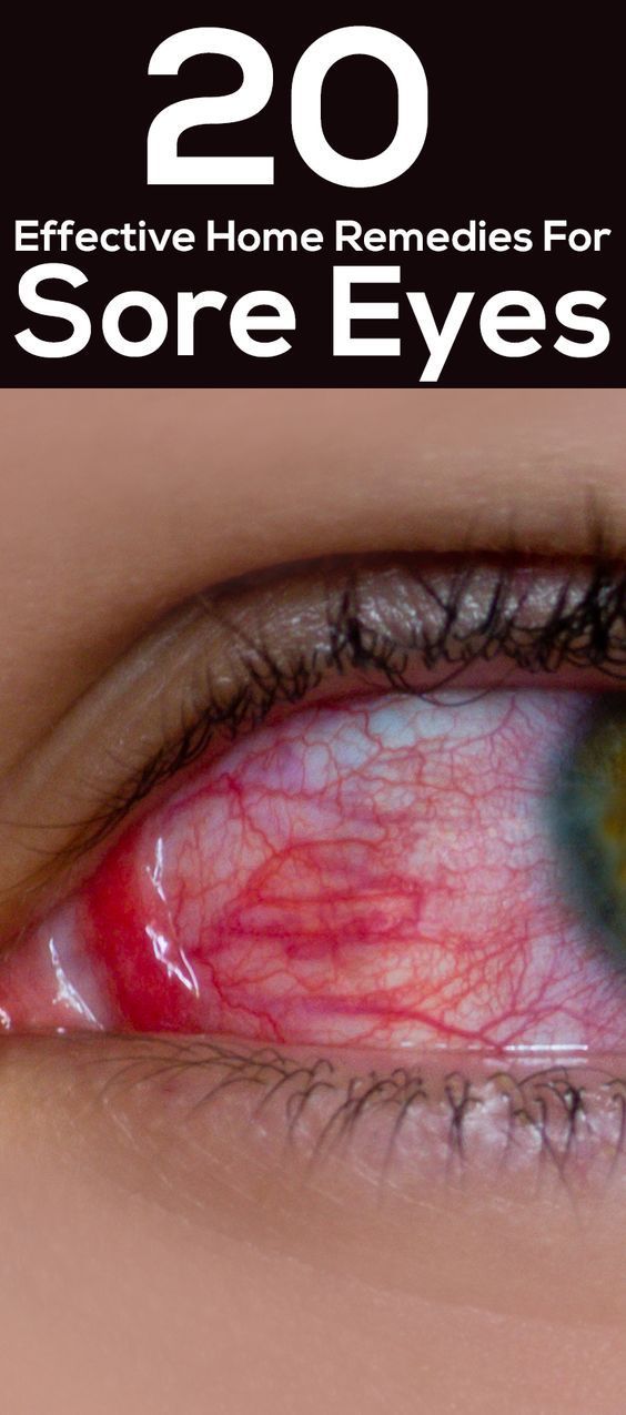 how to prevent sore eyes home remedies