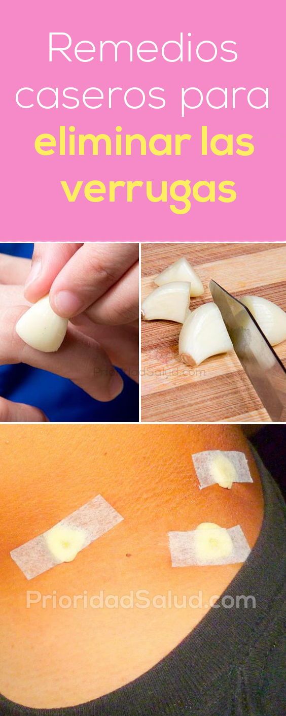como quitar las verrugas del cuello de manera natural como quitar las verrugas del cuello de manera natural