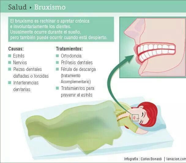 Bruxismo Ortodoncia Dental Protesis Dentales