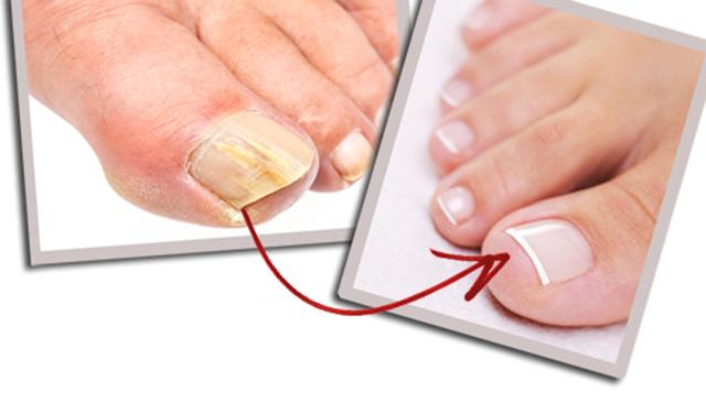 nail fungus szegfűszeg körömgomba kezelés megkezdése