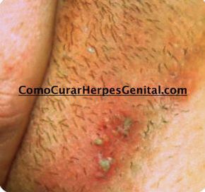 Papiloma humano labios genitales