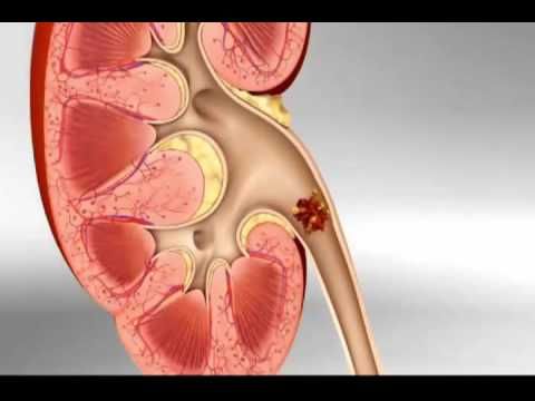 Kidney Disease Solution Ebook