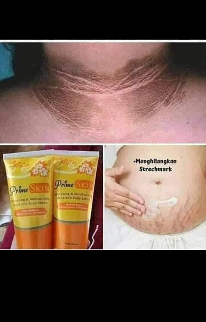 Cara menghilangkan bekas luka kena knalpot