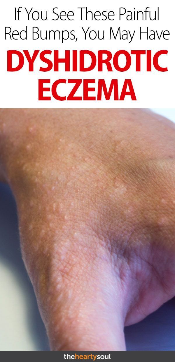 Pin On Ezcema Diet Pin On Ezcema Diet