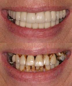 Girlfriend First Facial How Smoking Affects Your Teeth