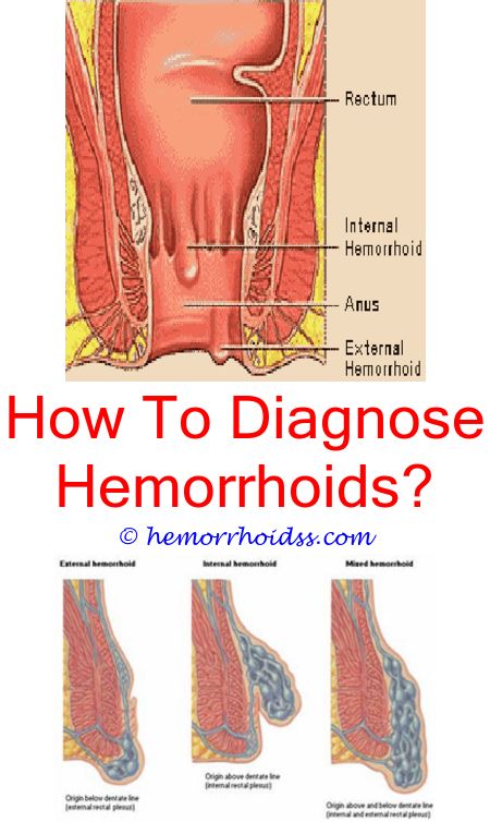 anal sex with hemorrhoid