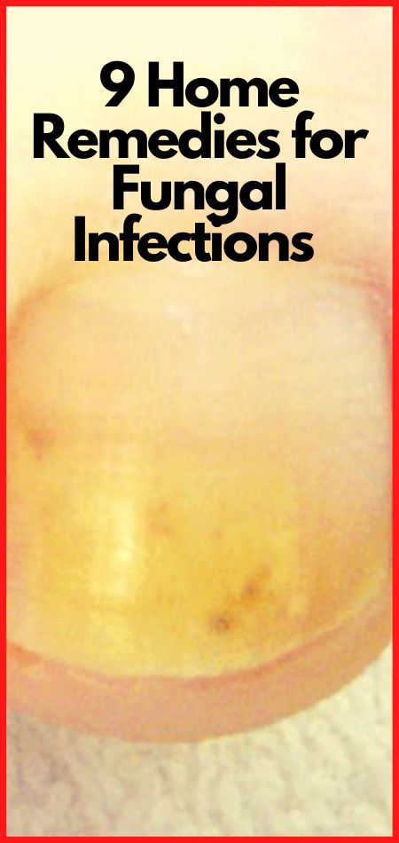 Are you looking for ways to get rid of toenail fungus at home fast. Here are the most effective toe nail fungus home remedies that will give you results instantly. #fungus #nailfungus #toenailfungus #fingernailfungus #homeremedies Fingernail Fungus, Feet Smelling, Fungal Infection, Tea Tree Oil, Toe Nails, Fungi, Home Remedies, Nail Polish
