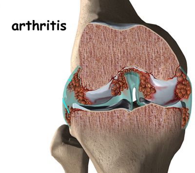 A rheumatoid arthritis