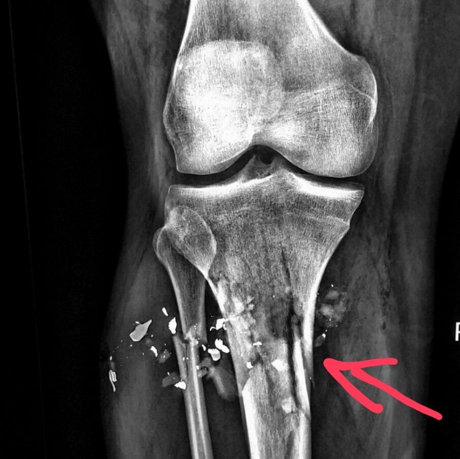 knee xray