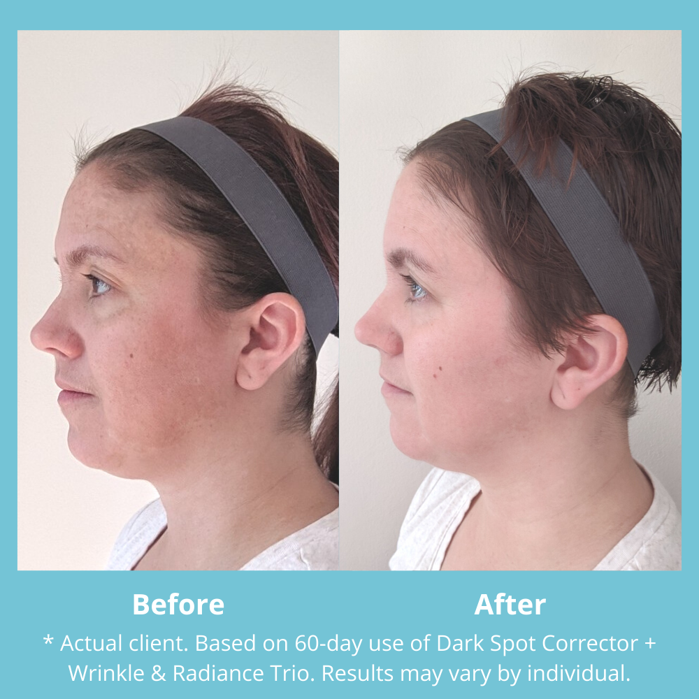 Everything you need for professional dark spot correction and multitasking skin rejuvenation. Dark Spot Essentials delivers clear, bright, even, nourished skin that looks and feels beautifully healthy, firm and supple! Dark Spot Corrector features Tranexamic acid, Bright Light Complex, Niacinamide, Licorice Extract, Lactic Acid and Alpha Arbutin—a proprietary mix designed to reduce the look of dark spots, post-acne marks and uneven skin tone. Wrinkle & Radiance Remedy PLUS features Retinol, Anti Aging Regimen, Top Anti Aging Products, Dark Spot Treatment, Laser Treatment, Post Acne Marks, Dark Spot Corrector, Brighten Skin Tone, Professional Skin Care Products