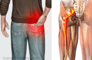 Como Aliviar El Nervio Ciatico Capri Pants Remedies