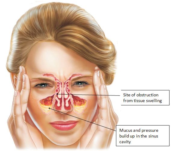 Natural Remedies For Sinus Ear Blockage Natural Remedies For Sinus Ear Blockage