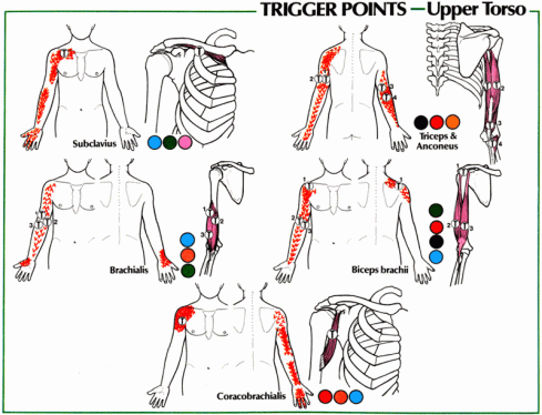 Shoulder Pain Referral Patterns Upper Torso PsoasRelease Psoas Extraordinary Pain Referral Patterns Shoulder Pain Referral Patterns Upper Torso PsoasRelease Psoas Extraordinary Pain Referral Patterns