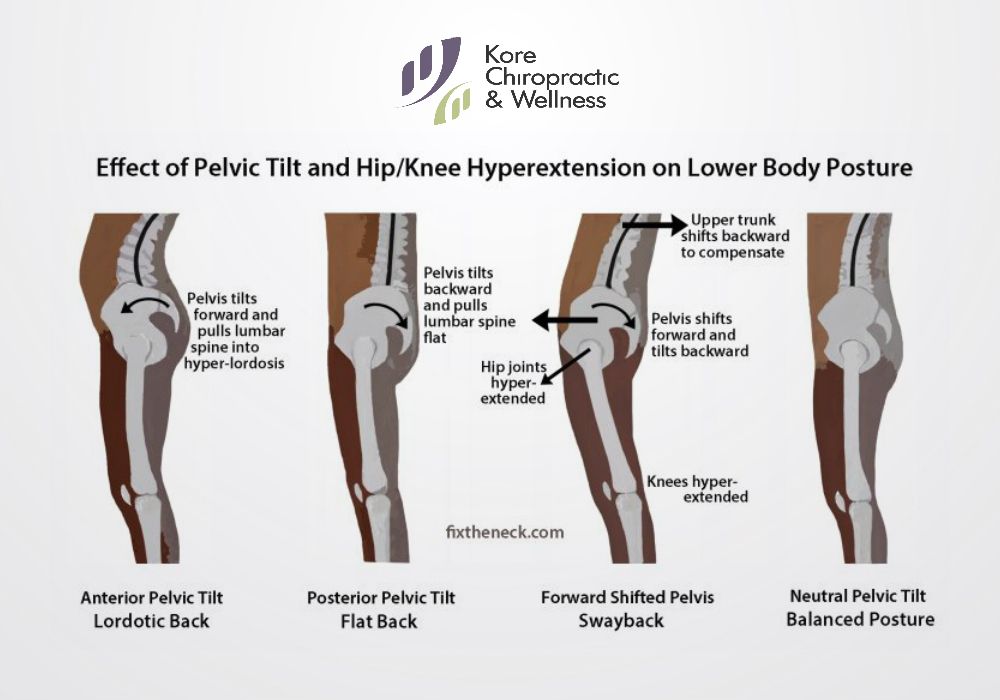 Effect Of Pelvic Tilt And Hip Knee Hyperextension On Lower Body Posture Posture Chiropractic Physio Body Posture Postures Pelvic Tilt