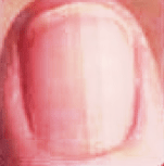 Beau S Lines Medicalopedia Fingernail Health Lines On Nails White Lines On Nails