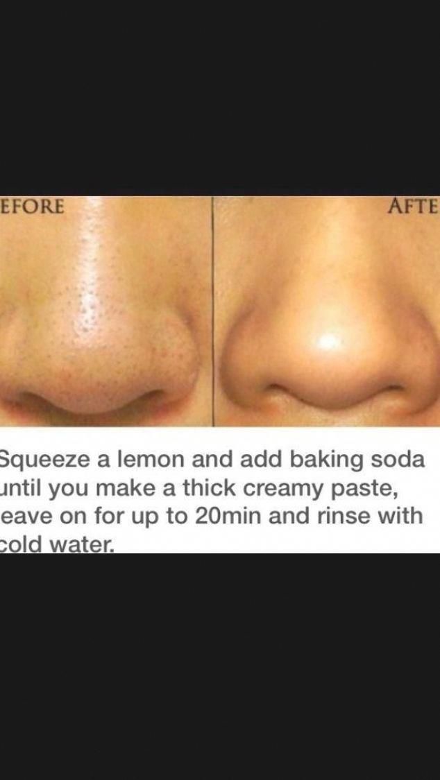 Blackhead Remover - Best Natural Ways to Remove Acne For Good. Diy Blackhead Remover Glue | Gelatin And Honey Face Mask | Removing Blackheads From Face. #drawings #Acne. #HerbsAndNaturalRemedies Honey Face Mask, Skin Care Face Mask, Honey Face Cleanser, Facial Cleanser, Homemade Face Masks, Homemade Skin Care, Easy Homemade, Face Mask For Blackheads, Removal Of Blackheads