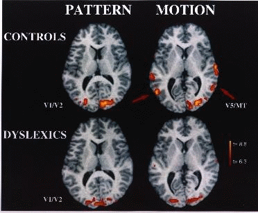 Dissertation learning disabilities