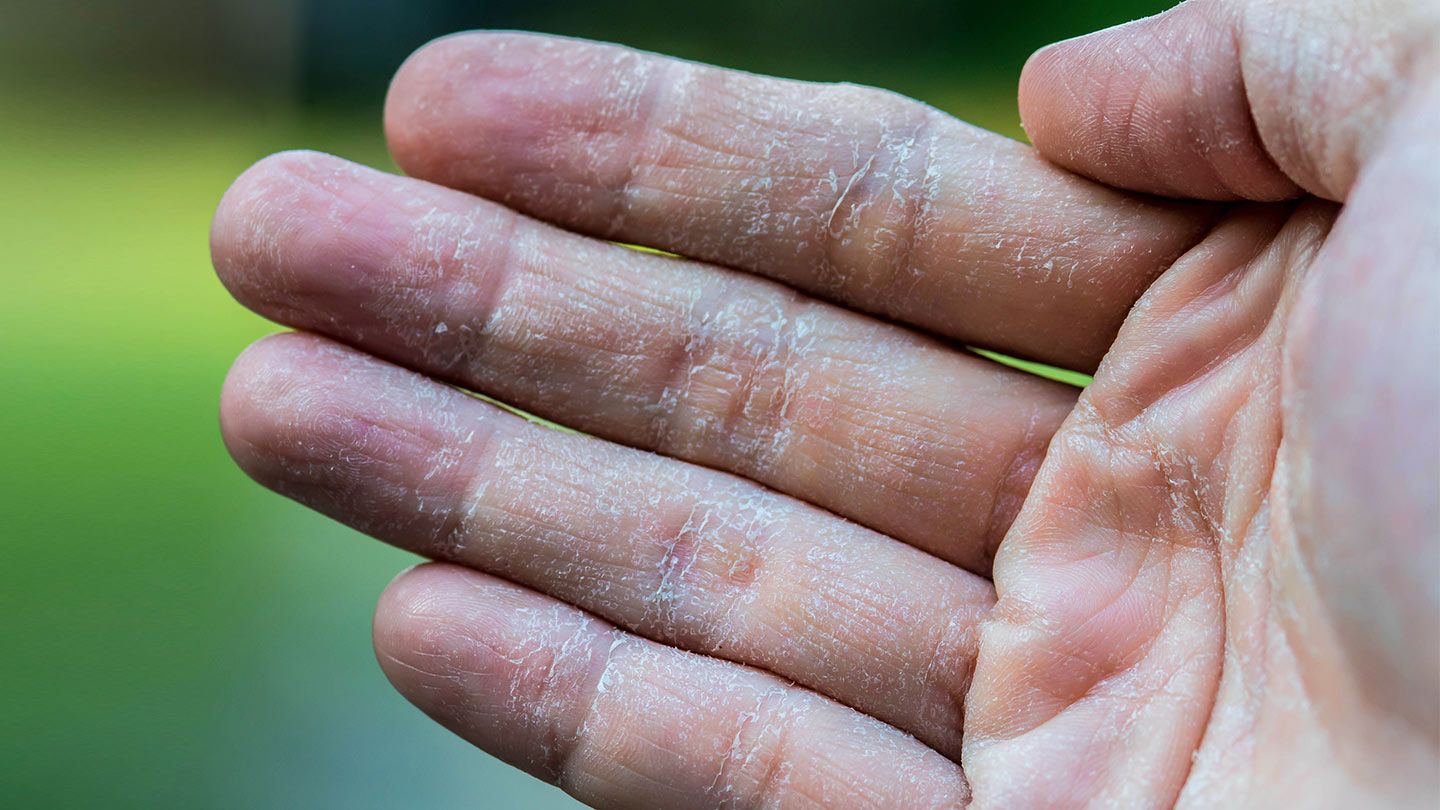 Celiac Disease Has A Little Sister Dermatitis Herpetiformis