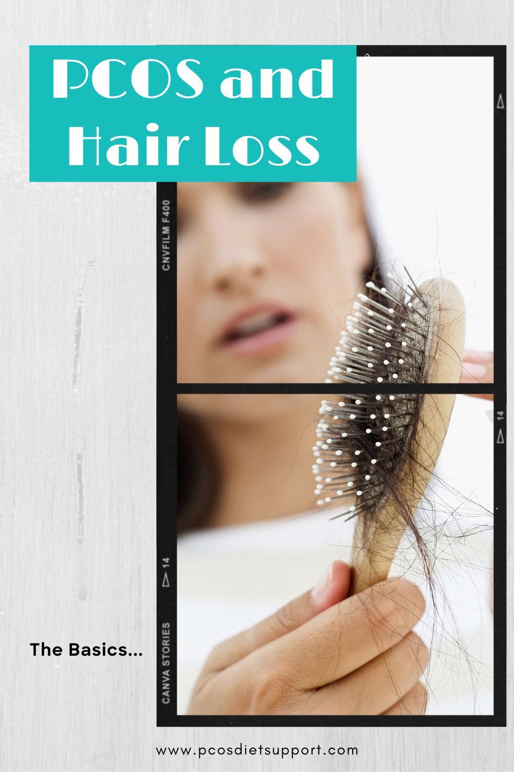 Hair loss or male pattern baldness is a common symptom of PCOS. The higher than normal testosterone levels can cause hair loss and thinning of the hair in some women with PCOS. Whilst this can be frustrating, there are some things that can be done to improve it. High Testosterone, Pcos Symptoms, Pcos Causes, Polycystic Ovarian Syndrome, Ovarian Cyst, Male Pattern Baldness, Pcos Diet, Endometriosis