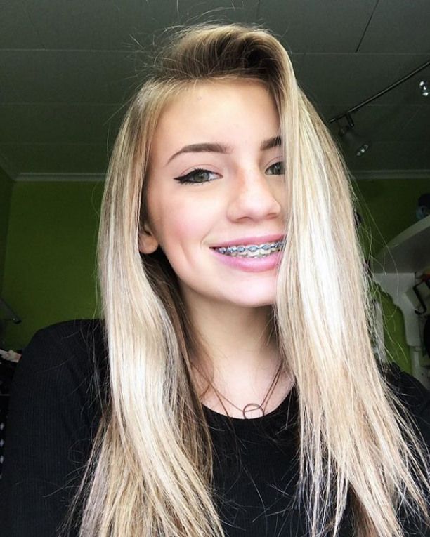 Cute Girl Braces For Teeth Cute Girl Braces For Teeth