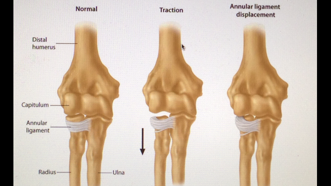 AStepAway New Search Experience Subluxation Tennis Elbow Elbow astepaway-new-search-experience-subluxation-tennis-elbow-elbow