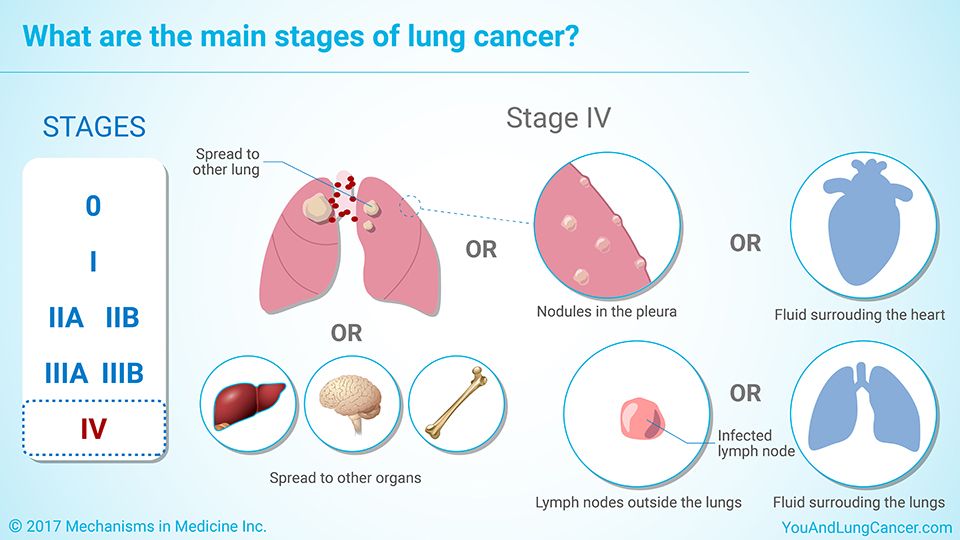 Stages of cancer