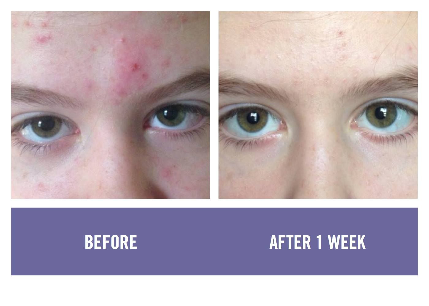 proactive before and after