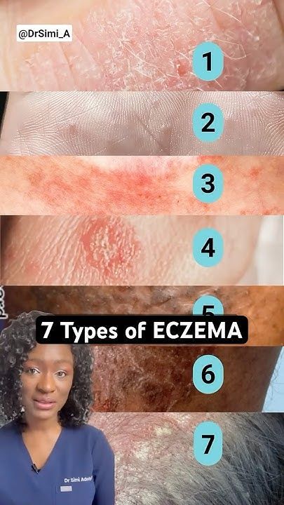 7 Eczema Types: How to Tell Which One You Have?