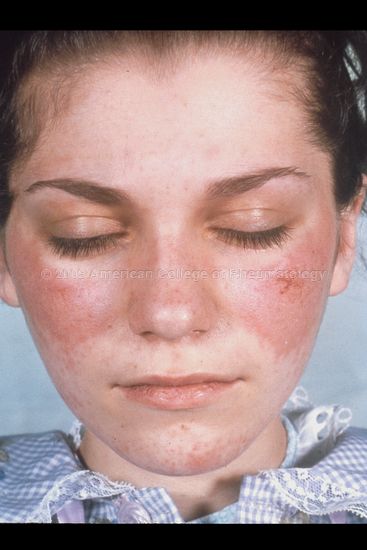Malar Rash Natural Treatment Malar Rash Natural Treatment