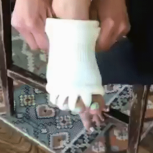 Indicațiile de tratament pentru hallux valgus