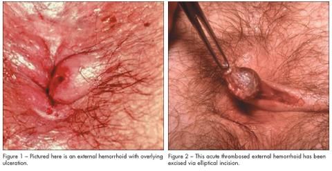 thrombosed hemorrhoids 101 a guide to thrombosed hemorrhoids relief