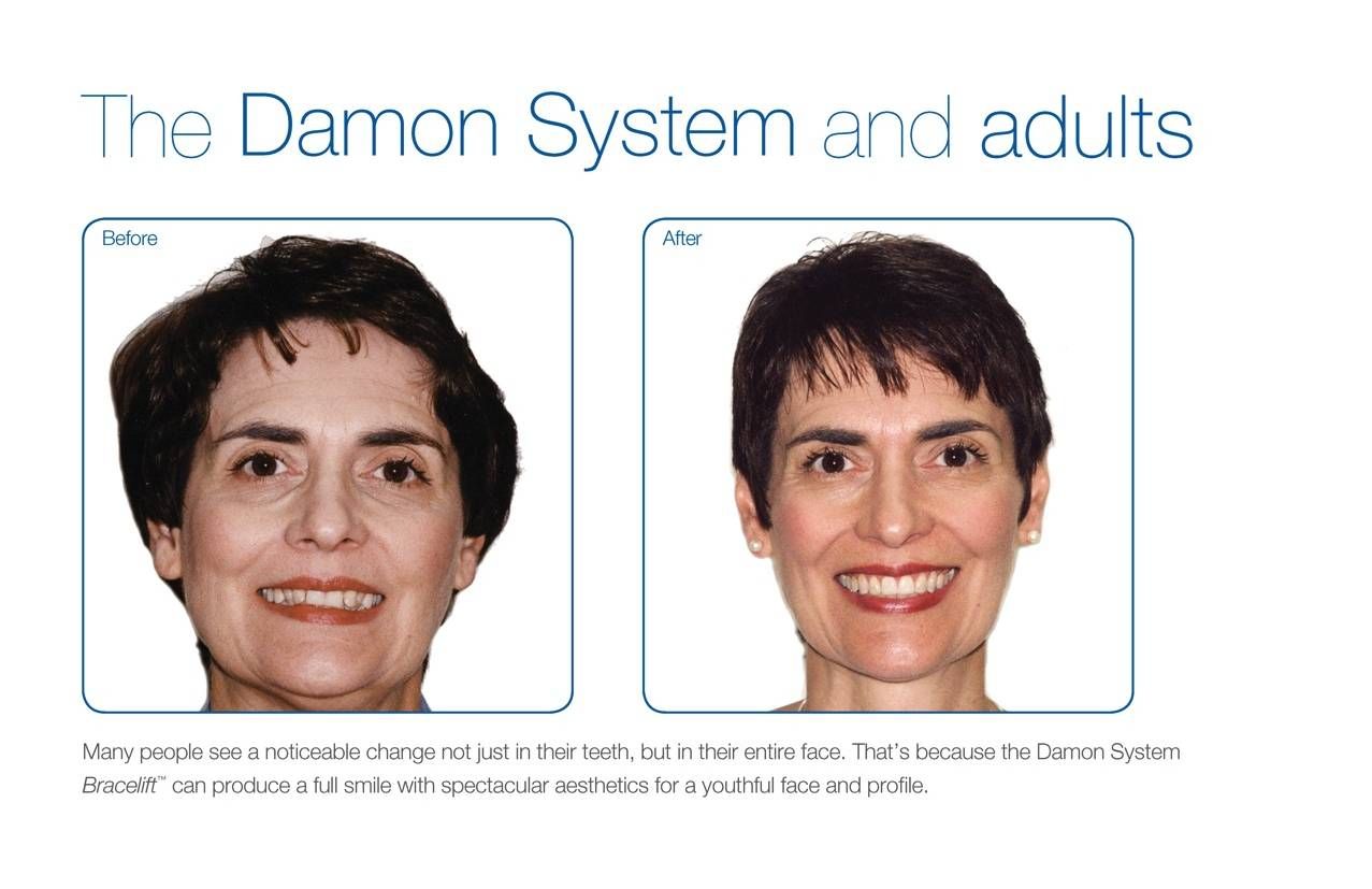 Damon System braces can produce a full smile with spectacular