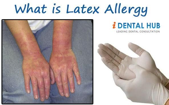allergic reations to latex Allergic reations to latex