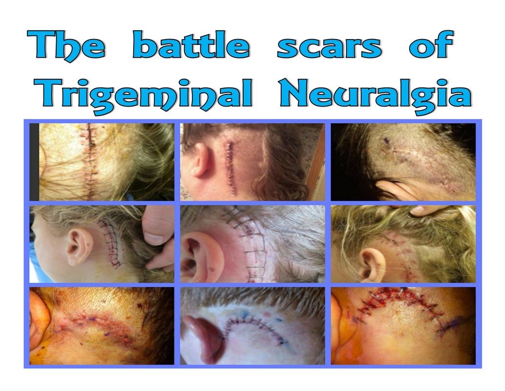 Letter to Doctors describing our frustrations over Doctors giving up on us and their non knowledge of Trigeminal Neuralgia and Facial Pain Disorders. Trigeminal Neuralgia Symptoms, Glossopharyngeal Neuralgia, Brain Nerves, Cranial Nerves, Migraine Pain, Chronic Migraines, Ocular Migraine, Hair Loss After Baby, Fibromyalgia