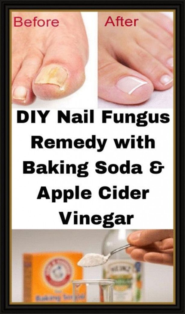 DIY Nail Fungus Remedy with Baking Soda & Apple Cider Vinegar 