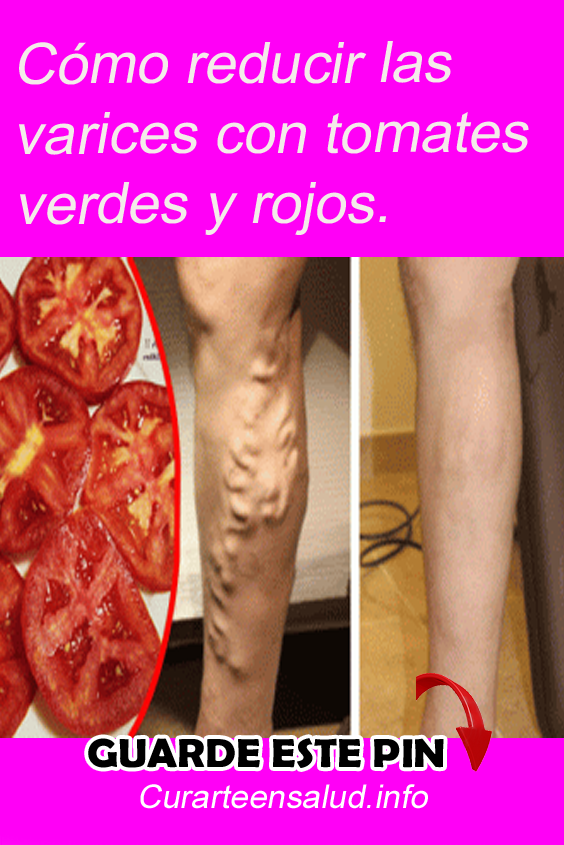 Como curar las varices con remedios caseros