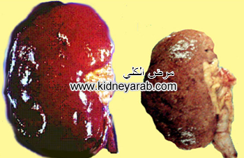 ما هو العلاج أفضل من غسيل الكلى يمكن أن يكون العلاج البديل للفشل الكلوي Kidney Failure Treatment Treatment Kidney Failure