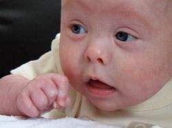 Physical Characteristics Associated With Down Syndrome Click To