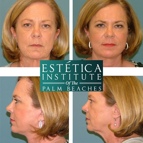 Palm Beach Gardens Plastic Surgeon From Rhode Island Board Certified Plastics Surgeons at Estetica Institute. Before and