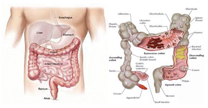 intraductal papilloma amboss parazitii rau sau