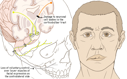 upper motor neuron lesion
